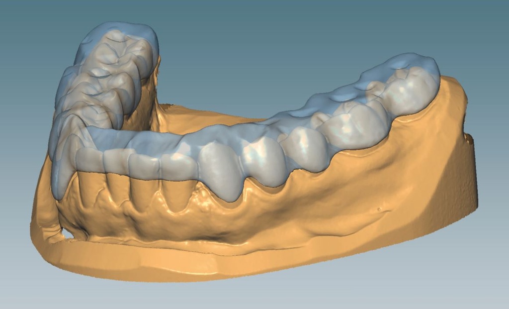 CERAMILL M SPLINT