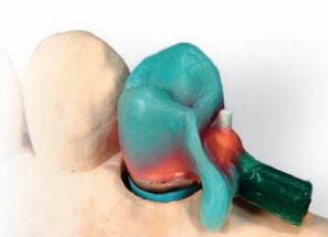 WIROFIX FRICTION ELEMENTS STANDARD