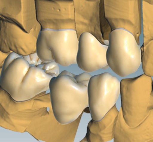 [AM179155] CERAMILL TRUE SMILE UPGRADE