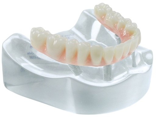 [SAMODCOMPLETE4] MODEL COMPLETE RESTORATION ON 4 IMPLANTS