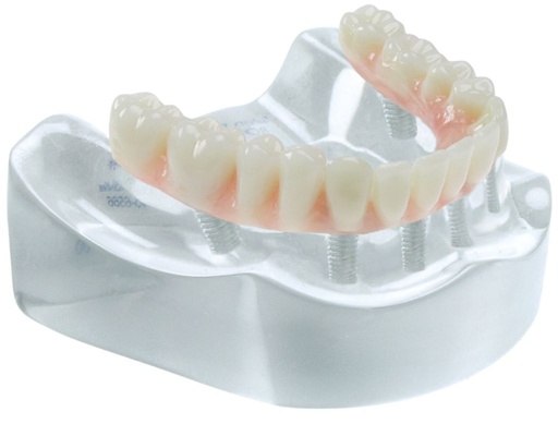 [SAMODCOMPLETE6] MODEL COMPLETE RESTORATION ON 6 IMPLANTS